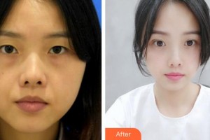 滕州時(shí)光醫(yī)療美容門診部許士海整形價(jià)格表附激光去眼袋案例展示