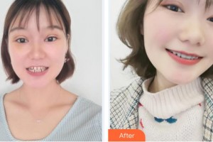 滕州時(shí)光醫(yī)療美容門診部王文科整形價(jià)格表附隱形托槽矯正案例展示