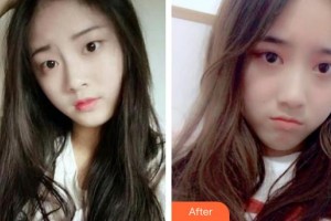 滕州市財(cái)貿(mào)醫(yī)院眼科孫友鵬整形價(jià)格表附眼部綜合案例展示