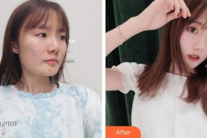 滕州美界醫(yī)療整形診所易彬整形價(jià)格表附切開雙眼皮案例展示