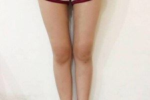 昆明醫(yī)學院整形美容中心如何？附吸脂瘦腿附果圖及價格一覽