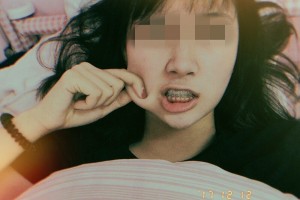 上海交通大學(xué)醫(yī)學(xué)院附屬第九人民醫(yī)院牙齒矯正附果圖