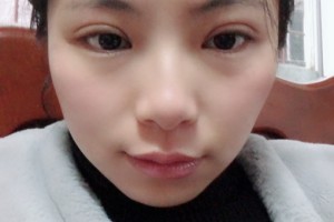 上海南山整容醫(yī)院割雙眼皮手術(shù)案例分享附價(jià)格表