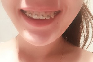 成都極光口腔醫(yī)院牙齒矯正多少錢附手術(shù)過(guò)程分享