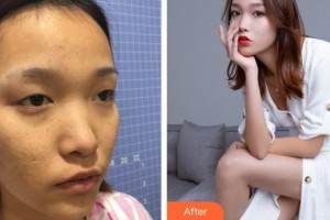 連云港贛榆國泰整形美容外科診所童飛整形價(jià)格表附眼部綜合案例展示