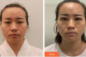 南昌大學附屬眼科醫(yī)院劉莉莉整形價格表附開內(nèi)眼角案例展示