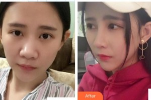 南昌愛爾眼科醫(yī)院黃海整形價(jià)格表附切開雙眼皮案例展示