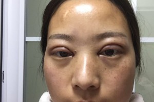 徐州醫(yī)科大學附屬醫(yī)院環(huán)境怎么樣雙眼皮手術果分享附價格一覽