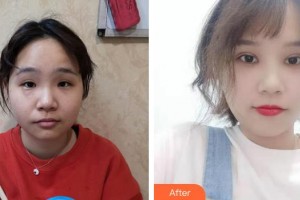 乳山新視力眼科醫(yī)院張軍富整形價(jià)格表附定點(diǎn)雙眼皮例展示
