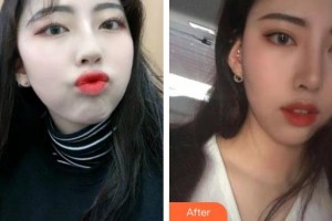 皖東人民醫(yī)院眼科陳東亮整形價(jià)格表附切開雙眼皮案例展示