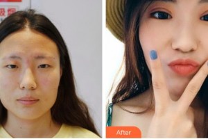 諸暨愛(ài)爾眼科醫(yī)院許如安整形價(jià)格表附切開雙眼皮案例展示