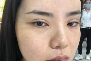 萬家燕王珍祥做下頜角怎么樣截的多嗎？附案例分享+較新價(jià)格表