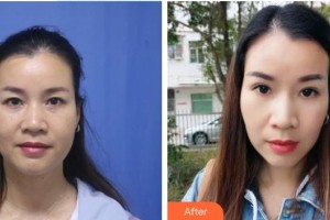 龍口光明眼科醫(yī)院于鵬林整形價(jià)格表附切開雙眼皮案例展示
