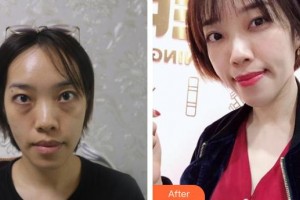 濟(jì)源現(xiàn)代女子醫(yī)院整形美容中心許方馨整形價格表附激光去眼袋案例展示