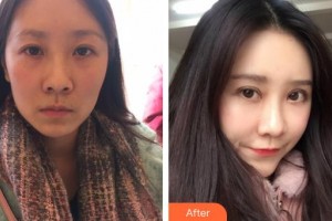 郯城新益民眼科醫(yī)院王濤整形價(jià)格表附切開雙眼皮案例展示