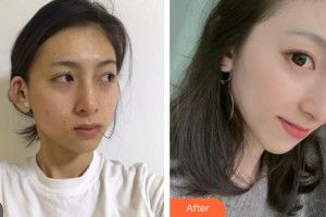 邯鄲京美整形醫(yī)院杜艷整形價(jià)格表附激光祛斑案例展示