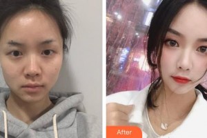 邯鄲華美醫(yī)療美容醫(yī)院姜?jiǎng)賱渍蝺r(jià)格表附紅藍(lán)光祛痘案例展示