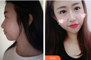 邯鄲愛爾眼科醫(yī)院李靜整形價格表附切開雙眼皮案例展示