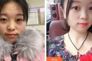 邯鄲貝潔口腔醫(yī)院滿玉娥整形價格表附金屬托槽矯正案例展示