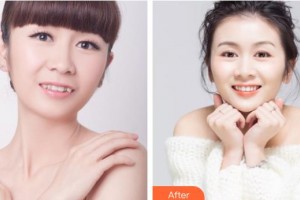 邯鄲佑熙醫(yī)療美容門診部孫堅(jiān)整形價(jià)格表附隱形托槽矯正案例展示