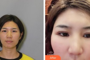 漢口愛爾眼科醫(yī)院劉兵整形價(jià)格表附眼部綜合案例展示