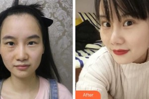 漢口愛(ài)爾眼科醫(yī)院吳立平整形價(jià)格表附眼部綜合案例展示