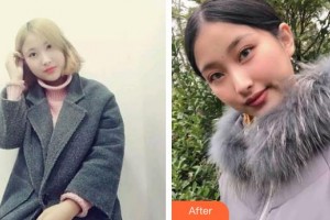 漢口愛(ài)爾眼科醫(yī)院鄭一晨整形價(jià)格表附眼部綜合案例展示