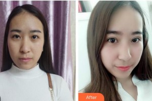 漢口愛(ài)爾眼科醫(yī)院劉俊杰整形價(jià)格表附埋線雙眼皮案例展示