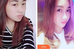 湘西麗人整形美容醫(yī)院徐娟整形價(jià)格表附切開(kāi)雙眼皮案例展示
