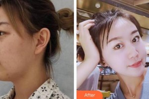 湘西愛(ài)爾眼科醫(yī)院譚米特整形價(jià)格表附眼部綜合案例展示