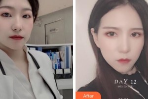 深圳德視佳眼科門(mén)診部姚文琴整形價(jià)格表附切開(kāi)雙眼皮案例展示