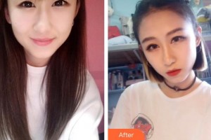 深圳德視佳眼科門診部謝繼歡整形價格表附眼部綜合案例展示