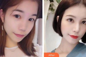 深圳華夏眼科醫(yī)院趙鐵英整形價格表附內(nèi)切祛眼袋案例展示