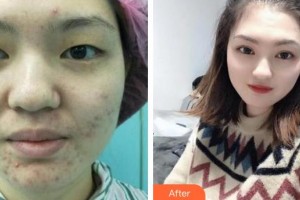 深圳希瑪林順潮眼科醫(yī)院林順潮整形價格表附眼部綜合案例展示