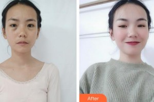 深圳愛爾眼科醫(yī)院黃麗娜整形價格表附埋線雙眼皮案例展示