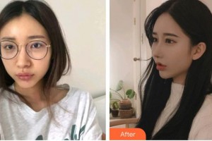 深圳愛爾眼科醫(yī)院喬曉望整形價(jià)格表附切開雙眼皮案例展示