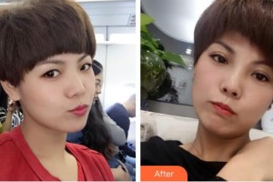 深圳愛爾眼科醫(yī)院胡尊霞整形價(jià)格表附定點(diǎn)雙眼皮案例展示