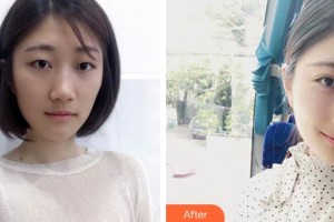 深圳愛爾眼科醫(yī)院林偉璇整形價(jià)格表附眼部綜合案例展示