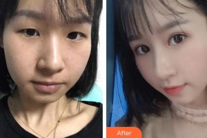 深圳愛爾眼科醫(yī)院凌受良整形價(jià)格表附切開雙眼皮案例展示