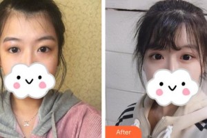 深圳愛爾眼科醫(yī)院謝金榮整形價(jià)格表附眼部綜合案例展示