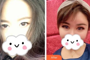 深圳愛爾眼科醫(yī)院尹海泉整形價(jià)格表附眼部綜合案例展示