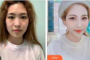 深圳愛爾眼科醫(yī)院周月芷整形價(jià)格表附眼部綜合案例展示