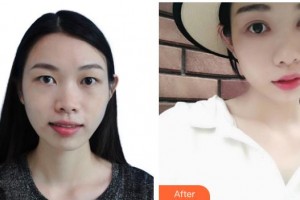 深圳?，斄猪槼毖劭漆t(yī)院施禮康整形價(jià)格表附切開雙眼皮案例展示