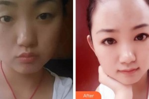 深圳?，斄猪槼毖劭漆t(yī)院卡夫恩整形價(jià)格表附眼部修復(fù)案例展示
