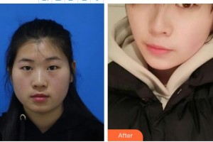 深圳?，斄猪槼毖劭漆t(yī)院黃俊華整形價(jià)格表附眼部綜合案例展示
