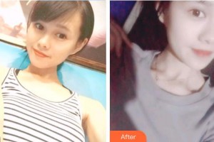 深圳?，斄猪槼毖劭漆t(yī)院孫紅整形價(jià)格表附切開雙眼皮案例展示