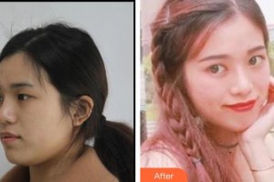 深圳?，斄猪槼毖劭漆t(yī)院尉洋整形價(jià)格表附眼部綜合案例展示