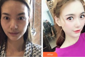 深圳?，斄猪槼毖劭漆t(yī)院袁野整形價(jià)格表附眼部修復(fù)案例展示