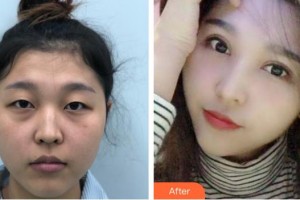 深圳?，斄猪槼毖劭漆t(yī)院林小銘整形價(jià)格表附眼部綜合案例展示
