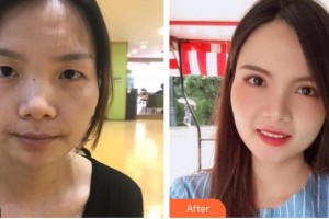 深圳?，斄猪槼毖劭漆t(yī)院舒敏整形價(jià)格表附切開雙眼皮案例展示